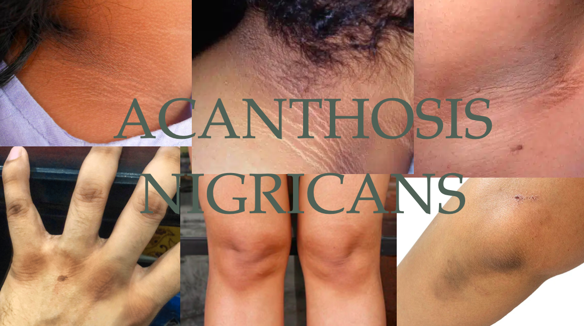 Acanthosis Nigricans: Not Just A Local Skin Issue…